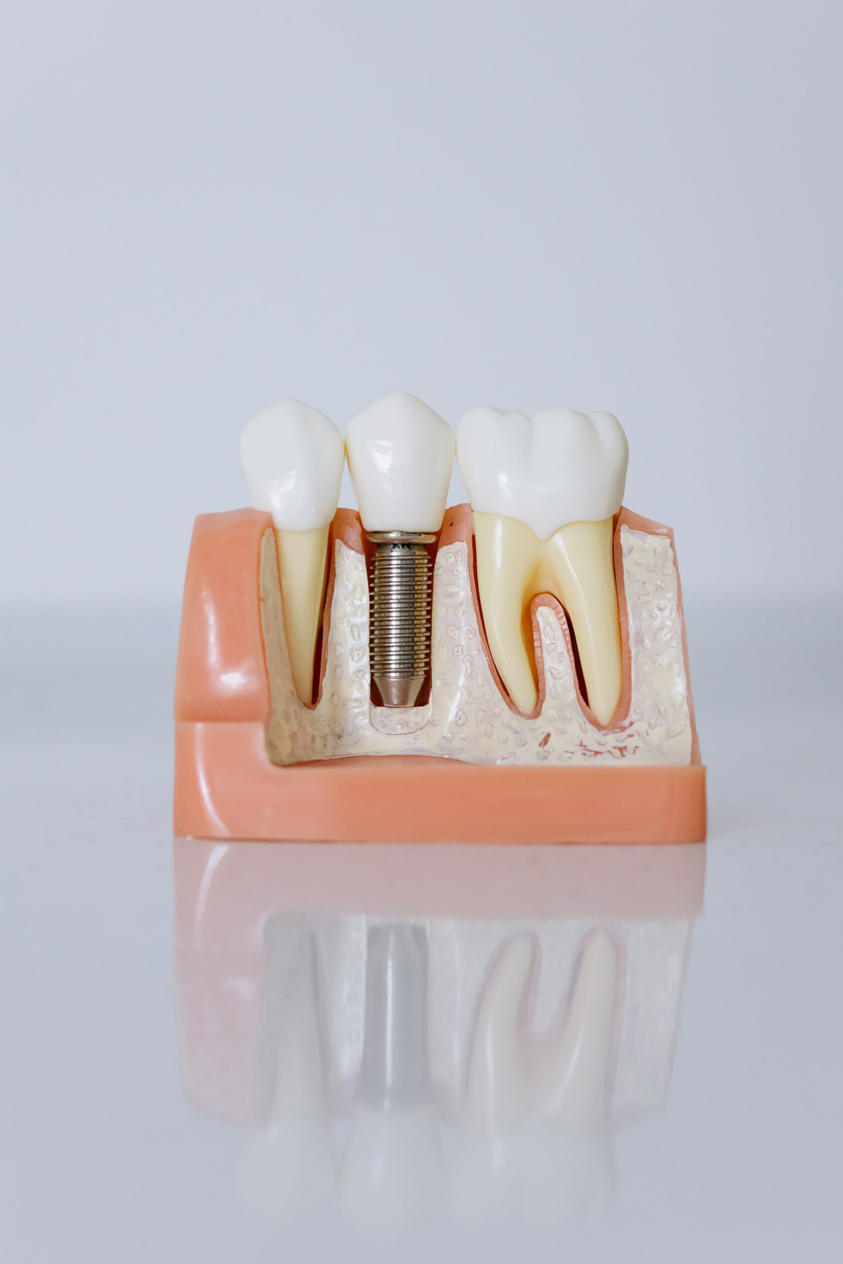 Dental Implant Model Clean White