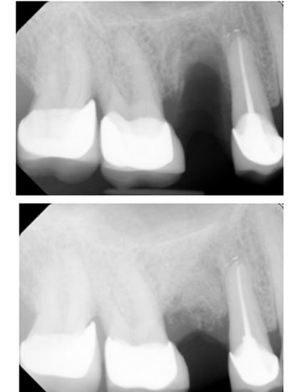 Bone Graft Before And After