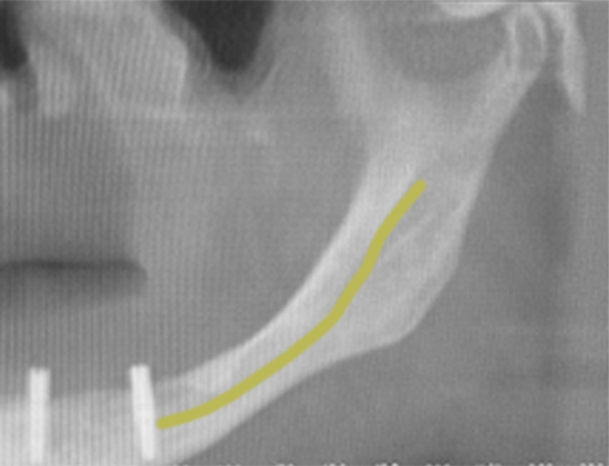 X-Ray of Nerve Repositioning for Implant Placement