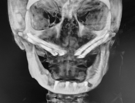 Implant Reconstruction Radiograph (Quad Zygoma procedure)