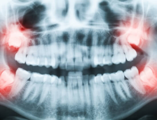 Wisdom Teeth Highlight X-Ray